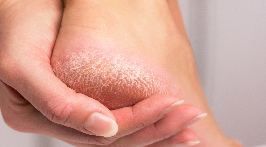Can A Podiatrist Remove Dead Skin on the Feet?