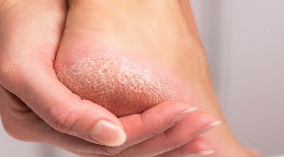 How to Remove Dead Skin from Your Feet - ePodiatrists