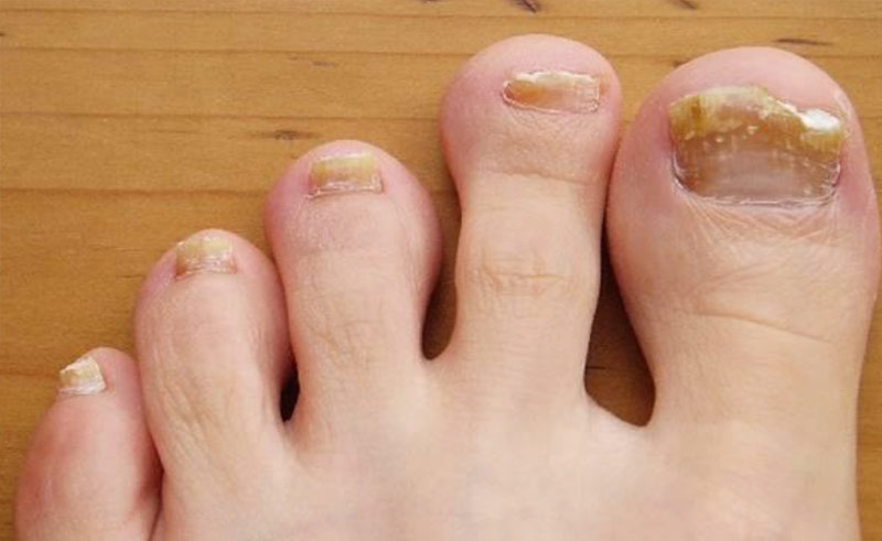 10 things your nails could be telling you about your health