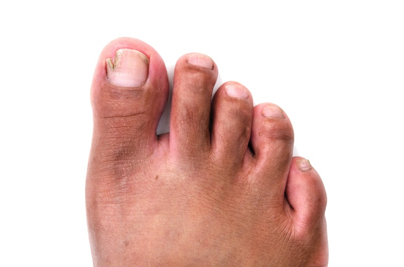 Ingrown Toenail Symptoms, Causes and Treatment