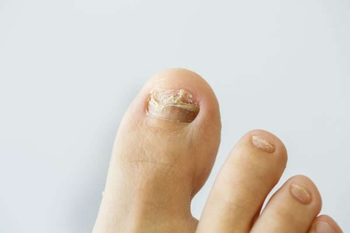 Solutions for Toenail Fungus